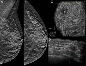 Mamografía en proyecciones oblicua y craneocaudal (A y B) que fue interpretada como BI-RADS 2 en una paciente de 67 años. Tanto en el plano coronal de ABUS (círculo en C) como en el plano axial (flecha en D) se visualiza una lesión nodular cuyo resultado histológico fue de carcinoma ductal infiltrante de grado intermedio.