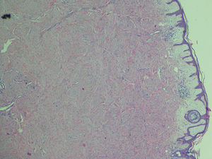 Tinción de hematoxilina-eosina, 4×. A pequeño aumento se aprecia una proliferación dérmica de agregados celulares fusiformes entrelazados de forma irregular con fibras de colágeno. La epidermis se encuentra respetada, así como la parte superior de la dermis.