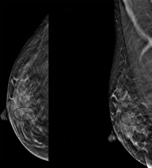 Distorsión arquitectural visible con tomosíntesis proyectada en la región central de la mama derecha (círculo). El resultado anatomopatológico fue hiperplasia ductal atípica.