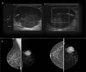 Estudio radiológico mamario: A) Mamografía (proyección mediolateral oblicua y craneocaudal): lesión nodular densa de 40mm en CSE-MI parcialmente definida. BI-RADS IV. B) Ecografía mama-axila: nódulo sólido de 38mm de diámetro, con vaso prominente con flujo en región central. Axila sin hallazgos patológicos. BI-RADS IV.