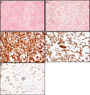 Estudio histológico-inmunohistoquímico: A) Proliferación de células fusiformes. B) Patrón infiltrativo en el tejido circundante. C) Vimentina (marcador estromal). D) Tinción de citoqueratinas AE1-AE3 (marcador epitelial). E) Tinción de los núcleos de las células mioepiteliales con p63.