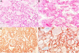 Upper pictures show microcystic pattern, as well as vacuolated cytoplasm in some cells (A and B). Lower pictures show S-100 positive protein in nucleus and cytoplasm (C and D).