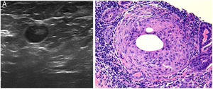 A) Imagen nodular e hipoecogénica de aproximadamente 1cm de diámetro compatible con quiste sólido mamario. B) Imagen histológica en la que se aprecia granuloma no caseificante adyacente a un conducto mamario. Ambas pertenecientes a la paciente del caso 1 (tinción hematoxilina-eosina, x100).
