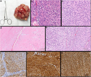 Estudio histopatológico-inmunohistoquímico (IHQ). a)macroscópico: pieza quirúrgica de la exéresis de la lesión; b)tinción hematoxilina-eosina (HE) (20×); células fusiformes en empalizada. c)HE (20×); núcleos con aspecto vesiculoso con nucléolo evidente. d)HE (20×); áreas hipocelulares; e)HE (20×))áreas hipercelulares; f)IHQ positiva para S-100; g)IHQ positiva para CD34; h)IHQ positiva para vimentina.