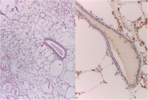 Estudio histopatológico de la lesión. Imágenes de microscopia óptica. Izquierda: tinción hematoxilina eosina a 4× aumentos; derecha: tinción inmunohistoquímica CD68 a 20× aumentos. En ambas imágenes se observan histiocitos vacuolados, citoplasmas ópticamente vacíos y células gigantes multinucleadas.