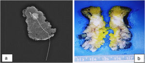 a) Imagen radiológica de la pieza quirúrgica con arpón. b) Macro de la pieza quirúrgica (fotos originales del paciente).