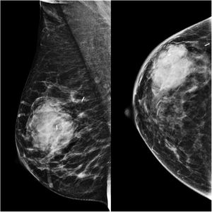 Mamografía vistas MLO y CC.