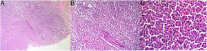 A) Densa infiltración de células plasmáticas neoplásicas oscureciendo el tejido mamario, dejando intacto alveolos y ductos (×4). B) Infiltración difusa en manto de células neoplásicas (×10). C) Diferenciación plasmocítica en células tumorales: núcleos vesiculares, abundante citoplasma basófilo, zonas pálidas perinucleares, visualizándose formas inmaduras de células plasmáticas por presencia de nucléolos (×40).