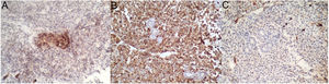 Inmunohistoquímica: A) Emma positivo, tinción citoplasmática y de membrana en grupo de células tumorales. B) Cadena ligera kappa positivo. Tinción citoplasmática en células tumorales. C) Cadena ligera lambda negativo.