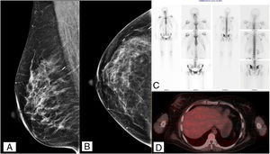 A) Mamografía MLO. B) Mamografía CC. C) Gammagrafía ósea. D) PET SCAN estudios de imagen posterior al tratamiento.