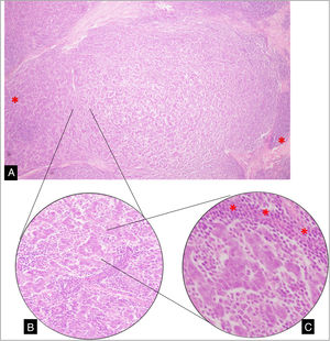 A) Sección de tumor de mama en el que se observa formación nodular de células anaplásicas, entremezcladas y rodeadas (*) por un prominente componente linfoplasmocitario (10X). B) Disposición en cordones de células que se anastomosan (20X). C) Células anaplásicas con márgenes citoplasmáticos poco definidos con patrón de crecimiento predominantemente sincitial, rodeadas de linfocitos (*) y escasas formaciones tubulares (40X).