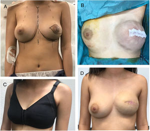 A) Planificación quirúrgica previa a mastectomía izquierda con reconstrucción inmediata. B) Resultado inmediato de mastectomía izquierda. C y D) Resultado al mes de la cirugía.