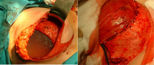 Reconstrucción mediante implante directo alojado en bolsillo retropectoral y cubierto inferiormente por colgajo dermograso.