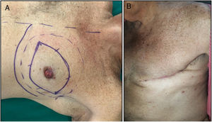 A)Prequirúrgico: diseño de la incisión y marcaje del ganglio centinela. B)Resultado posquirúrgico, día36.