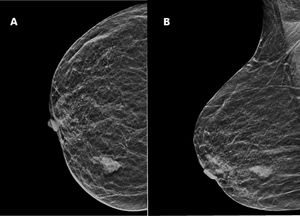 Mamografía: craneocaudal (A) y oblicua (B).