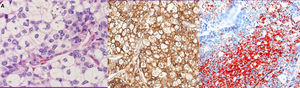 Microscópicamente, el tumor está formado por el crecimiento sólido de células pequeñas y redondas con citoplasma claro (A). Tinción positiva del antígeno epitelial de membrana (EMA) (B). Tejido fresco con células positivas al rojo oleoso (C).