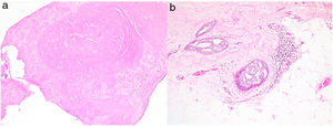 Biopsia por punción con diagnóstico de papiloma esclerosado (HE×40) (a). Pieza de resección con un carcinoma intraductal de bajo grado sin necrosis (HE×40) (b).