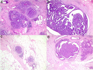 Pieza de resección con un carcinoma intraductal de bajo grado con necrosis (HE×40) (a) y un papiloma intraductal (HE×40) (b). Ampliación de la resección anterior con un carcinoma intraductal de bajo grado con necrosis (HE×40) (c) y un papiloma intraductal (HE×40) (d).
