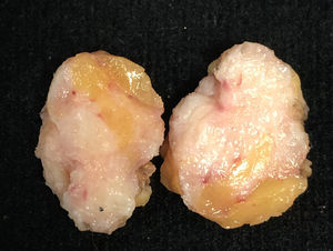 Macroscopic appearance of a surgical specimen removed due to a suspicious image on mammography. The patient was a 61-year-old FT with breast implants and under hormonal treatment. She was surgically treated for having a palpable and spiculated image at mammography which proved to be a benign lesion with stromal fibrosis.