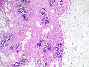 Histological image of the resection specimen with adipose tissue, connective tissue and duct-lobular units. This histological structure is the same that the one seen in the female breast (Same patient as Fig. 1) (H&E ×40).
