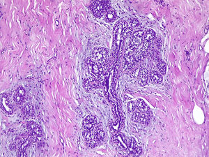 Detail of a ductal unit surrounded by alveolar sacs (Same patient as Fig. 1) (H&E ×100).