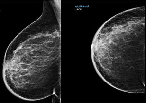 Mamografía mama derecha en proyección oblicua mediolateral y craneocaudal con engrosamiento cutáneo generalizado y aumento de densidad en cuadrante superoexterno (CSE) y retroareolar.