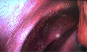 Imágenes intraoperatorias de la primera intervención que detectan implantes peritoneales a nivel de peritoneo en hemidiafragma derecho y epiplón.