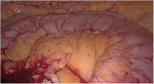 Imágenes intraoperatorias de la segunda intervención con implantes peritoneales en colon y peritoneo de mayor tamaño.