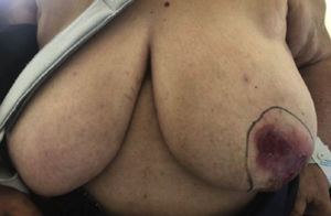 Irregular huge ulceration in a 76-year-old woman. Physical examination.