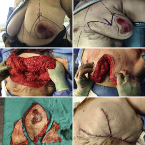 Conservative mastectomy including the NAC with a W pattern mammoplasty.