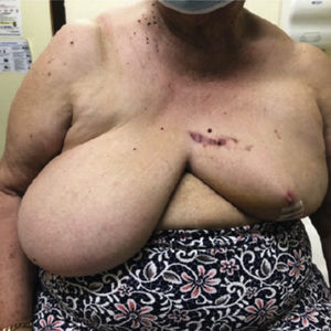 Aesthetic results two weeks after breast surgery.