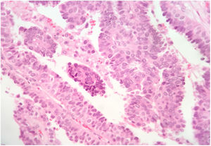 Microfotografía (HE, X200) que muestra el patrón papilar con finos ejes fibroconectivos, así como núcleos con escasa atipia, característicos de esta entidad. Nótese en la parte superior derecha, la presencia de células de citoplasma claro basales que simulan la presencia de células mioepiteliales.
