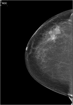 Mamografía, proyección craneocaudal del Caso 1 de mama derecha donde se objetiva trastorno arquitectural de 4 cm en relación con la cicatriz de tumorectomía.