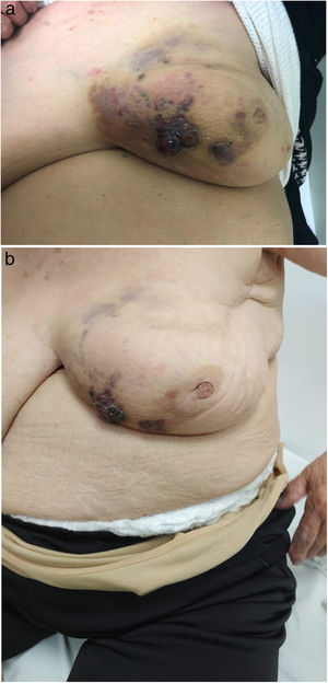 Lesión violácea oscura, sobreelevada y ulcerada a nivel del cuadrante inferointerno compatible con angiosarcoma de la paciente del Caso 2.