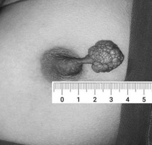 Polypoid lesion originating from the left nipple.