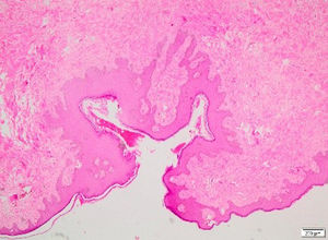 Histopathological findings: polypoidal lesion covered by squamous epithelium with fibrocollagenous hypocellular stroma and small vessels in the stroma (H&E).
