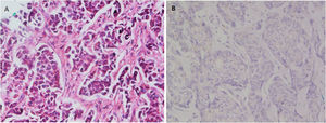 (A) A case of H&E stained primary breast duct carcinoma with no myoepithelial layer (200×). (B) Negative staining for p63 by immunohistochemistry.