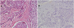 (A) A case of H&E stained metastatic breast duct carcinoma in axillary LN with no myoepithelial layer (200×). (B) Negative staining for SMMHC immunohistochemical marker.