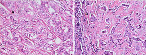 (A) A case of primary breast duct carcinoma grade2 (H&E stained, 200×). (B) Ipsilateral axillary LN metastasis, breast duct carcinoma grade2 (H&E stain, 200×).