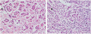 (A) A case of H&E stained primary breast duct carcinoma grade2 (200×). (B) Ipsilateral axillary LN metastasis, breast duct carcinoma grade3 (200×).