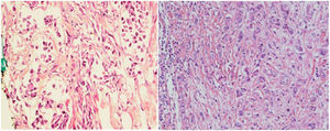 (A) A case of primary breast duct carcinoma grade3 (H&E stained, 200×). (B) Ipsilateral axillary LN metastasis, breast duct carcinoma grade2 (H&E stained, 200×).