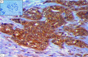 (A) A case of TNBC showing cytoplasmic Notch4 overexpression (diffuse and strong immunostaining) (×400). (B) Adjacent normal breast tissue showing negative Notch4 expression (×400).