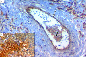 (A) A case of TNBC (medullary pattern) showing strong Notch4 immunoreactivity in vascular endothelium (white arrow) and neoplastic cells (black arrow) (×400). (B) showing increased staining intensity of neoplastic cells at the invasive edge (white arrow) (×400).