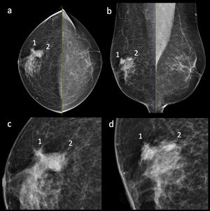 Craniocaudal (a) and mediolateral oblique (b) views with respective enlargements (c, d) of the right breast showing flame shaped ipsilateral densities radiating from the nipple, suggestive for gynecomastia. Two suspicious contiguous high-density masses with pleomorphic microcalcifications were shown in the superior outer quadrant. The smallest lesion (1) has irregular margins while the largest lesion (2) has partly lobulated and ill-defined margins.