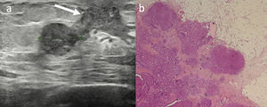 Ultrasonography (a) showing subareolar and central hypoechoic tissue which radiates posteriorly in the surrounding adipose tissue, suggestive for gynecomastia (white arrow). A 18mm hypoecoic lobulated nodule corresponding to the largest lesion on mammography (Fig. 1) was also detected. Breast biopsy was performed and breast invasive papillary carcinoma, with papillary and solid patter, was diagnosed (b).