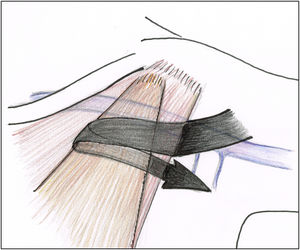 The arrow shows the maneuver to separate the minor and the major pectoralis muscles.