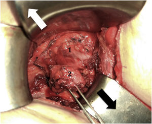 A surgical window is created to Berg's third level. White arrow: medially traction of major pectoralis muscle. Black arrow: laterally traction of minor pectoralis muscle. 1:axillary vein; 2: level III's fat tissue to be resected.