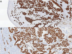 Metástasis cutánea por carcinoma de mama. A) Citoqueratina 19+; 4×; destaca la morfología papilar de la metástasis, con un componente ductal infiltrante clásico subepidérmico, que no se evidenció en la tumoración mamaria. B) 10×; la metástasis cutánea es intensa y difusamente positiva para receptores de estrógenos.