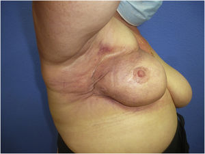 Imagen clínica de la placa inflamatoria indurada a la palpación.