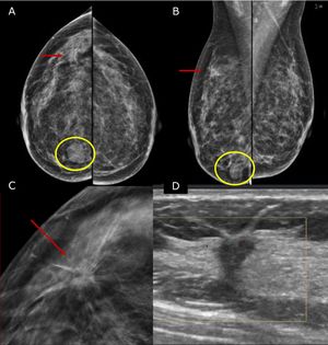 45 yo patient.first screening mammography. Digital Mammography in cranio caudal (A) and medio-lateral oblique (B) shows heterogeneously dense breasts with an oval shaped, well circumscribed margins, mass in the inner-inferior quadrant of the right breast (yellow circle, BI-RADS 2) and in the upper-outer quadrant of the same breast an architectural distortion which is better depicted in Digital Breast Tomosynthesis (C). The lesion had a sonographic appearance on B-mode (D) of a hypo-echoic mass, with micro-lobulated margins, posterior acoustic shadowing, and not-parallel orientation, highly suggestive for breast cancer (BI-RADS 5). The lesion was biopsied and histology revealed Invasive Ductal Cancer (ER+, PgR+, Her2neu−).